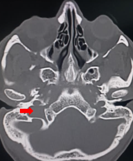 <p>Jugular Foramen.</p>