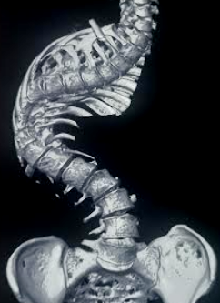 Scoliosis of the spine