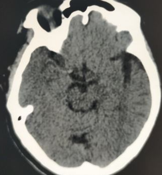 Right sided MCA 'cord sign' harbingering acute infarction