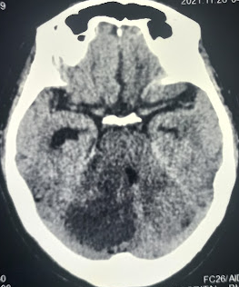 Acute cerebellar infarction