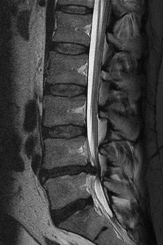 Lumbar disc extrusion