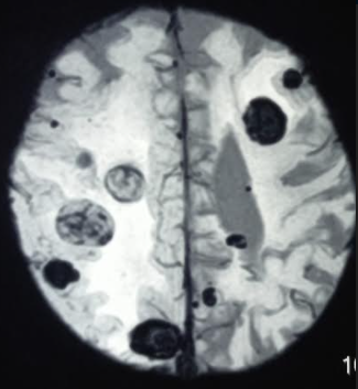 Multiple hemorrhagic metastasis to brain