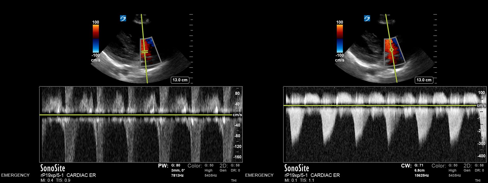 Figure 5: Example of high velocity tricuspid regurgitation jet imaged from parasternal window