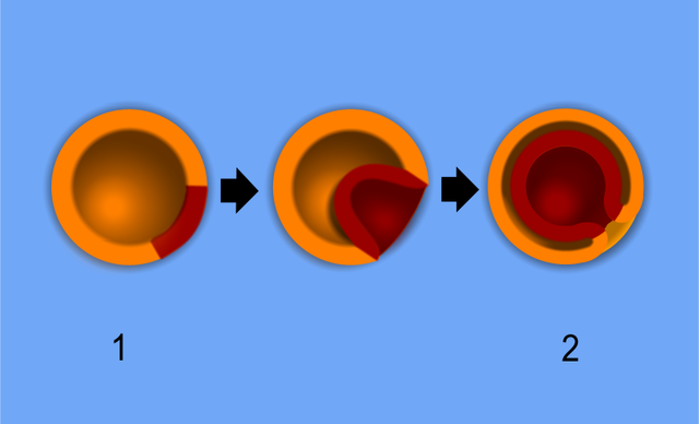 Diagram of gastrulation of a blastula.