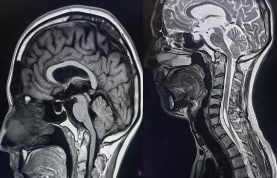 Syrinx secondary to basilar invagination