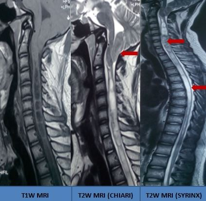 Holocord syrinx due to Chiari malformation