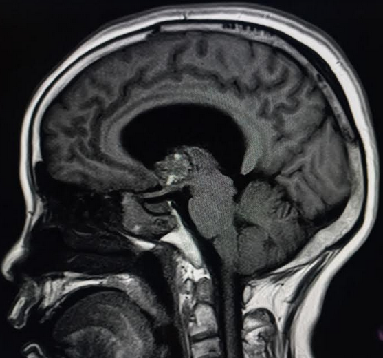 Third ventricular cavernoma