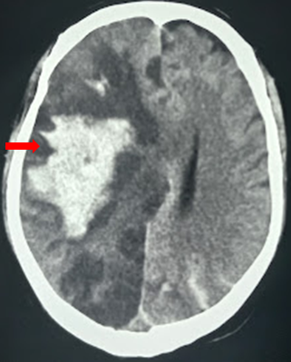 Hemorrhagic transformation in a ischemic stroke