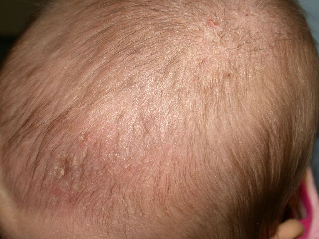 Cradle Cap