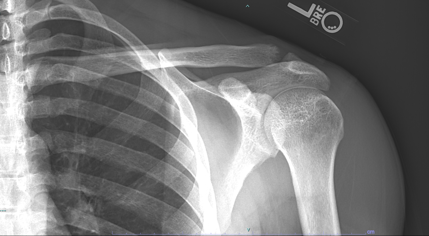 Distal Clavicular Osteolysis- XR showing subchondral bone cystic changes