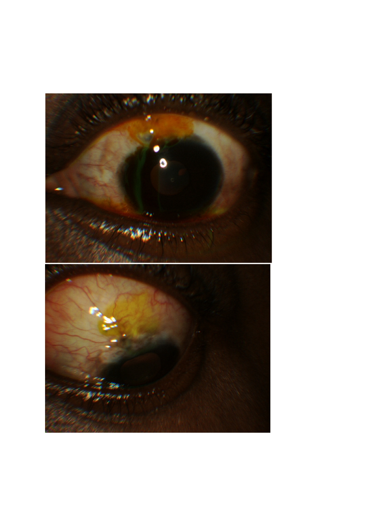 The Seidel test assesses for the occurrence of aqueous humor leakage through a defect in the integrity of the bleb