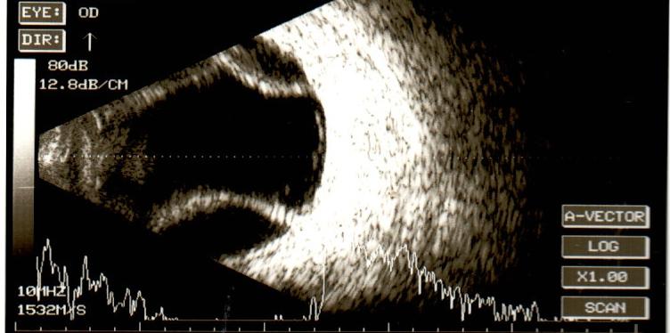 Post operative B scan of the right eye of a patient having hypotony after glaucoma filtering surgery.