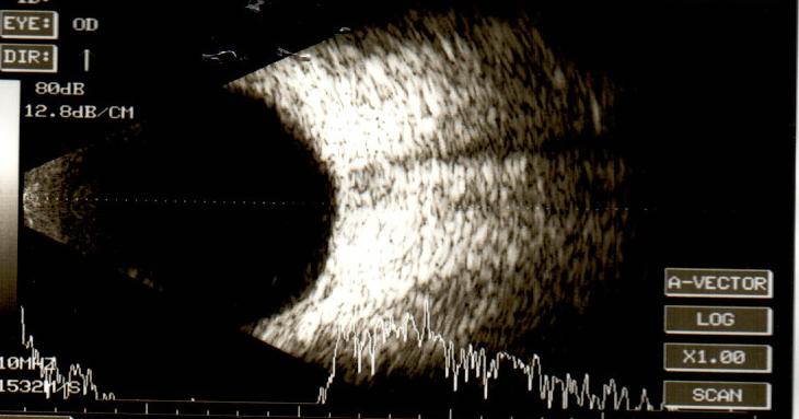 B scan of same eye after normalization of intraocular pressure with resolution of choroidal detachment.