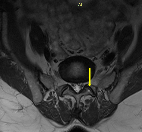 <p>Facet Joint</p>