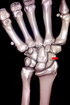 <p>Scaphoid Bone</p>