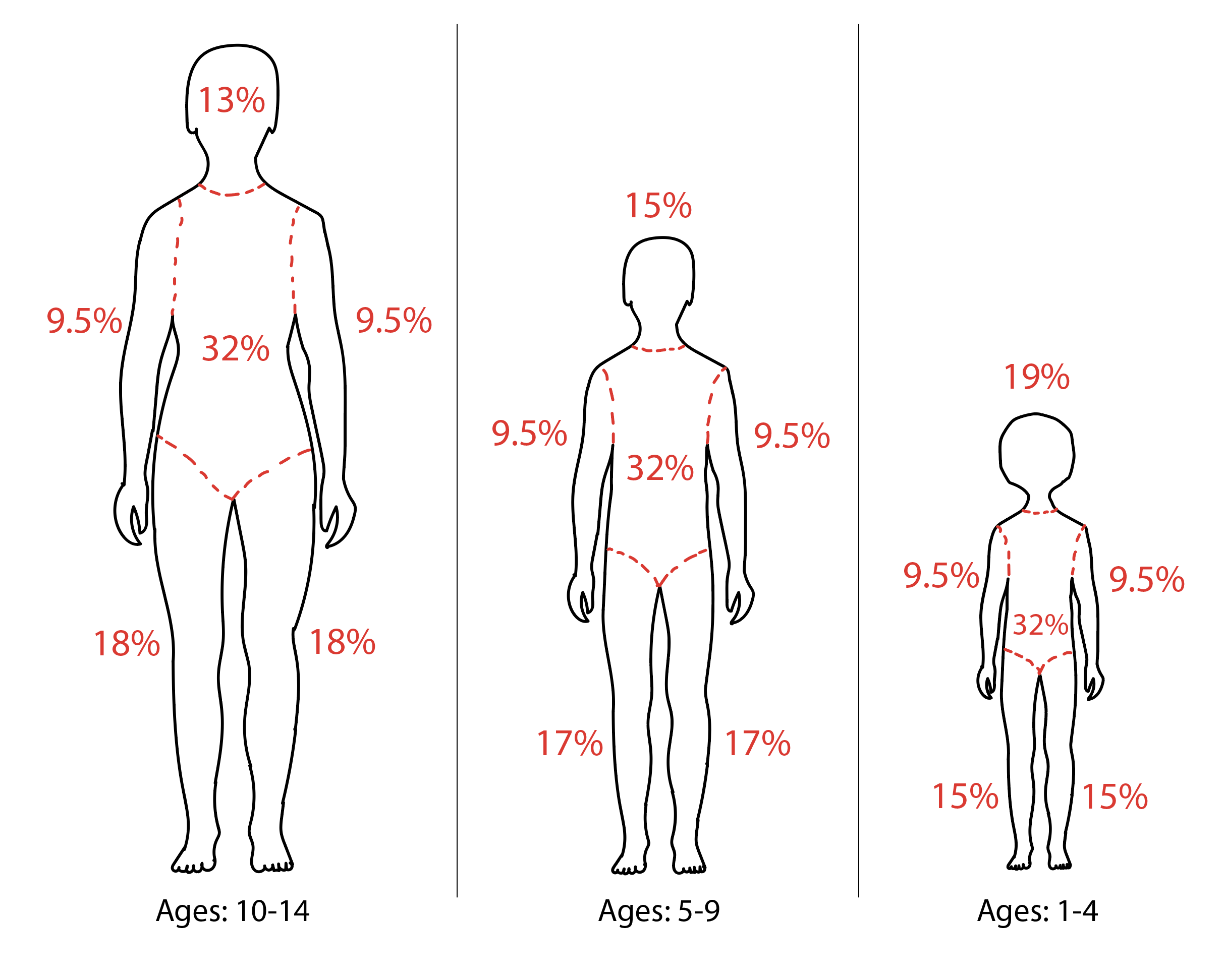 Diagram of rule of 9s modifications for pediatric patients.