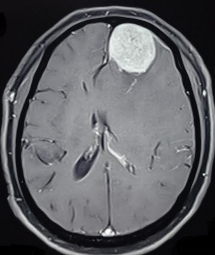 Parafalcine meningioma causing parafalcine herniation