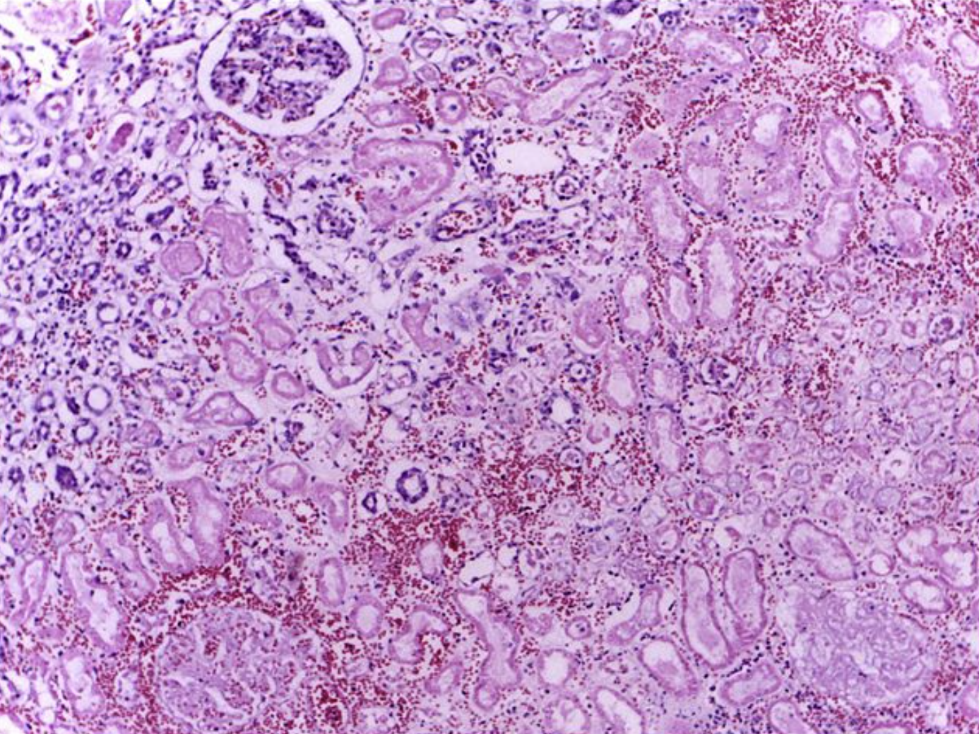 Per image author, "Edge of infarct shows normal kidney (upper left) with necrotic tubules and glomeruli in the infarct area having preserved cellular outlines with loss of nuclei