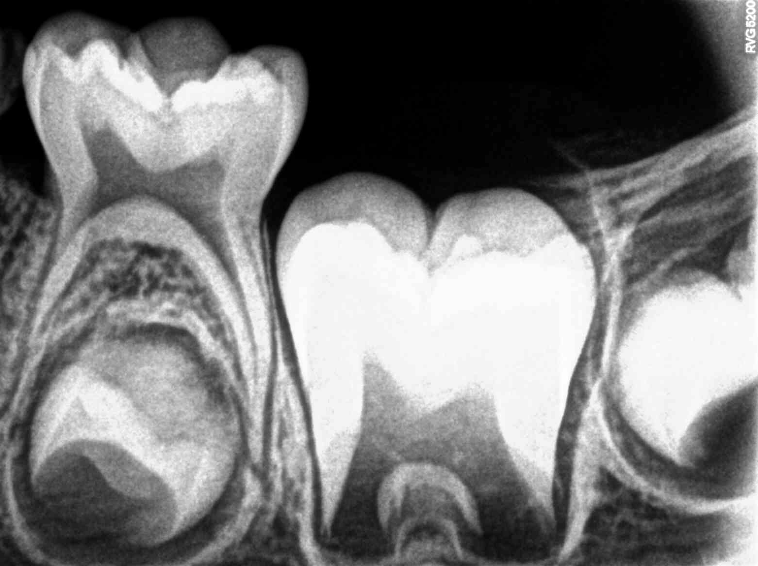 Intraoral Periapical Radiograph (IOPA) of a boy aged 5 years showing primary tooth #75 and developing crowns of permanent teeth 35, 36 and 37