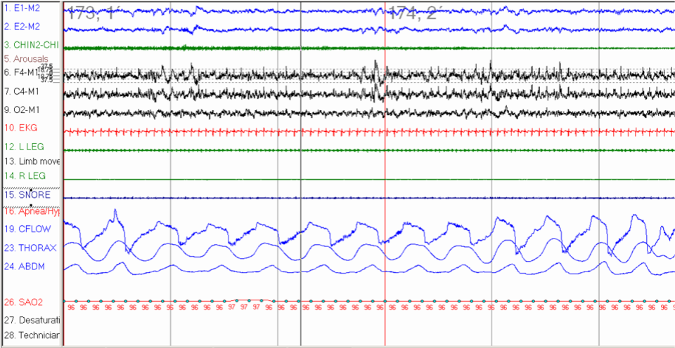 A polygraph recording during sleep