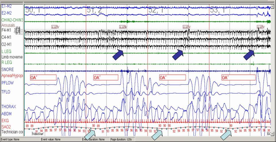 A polygraph recording during sleep