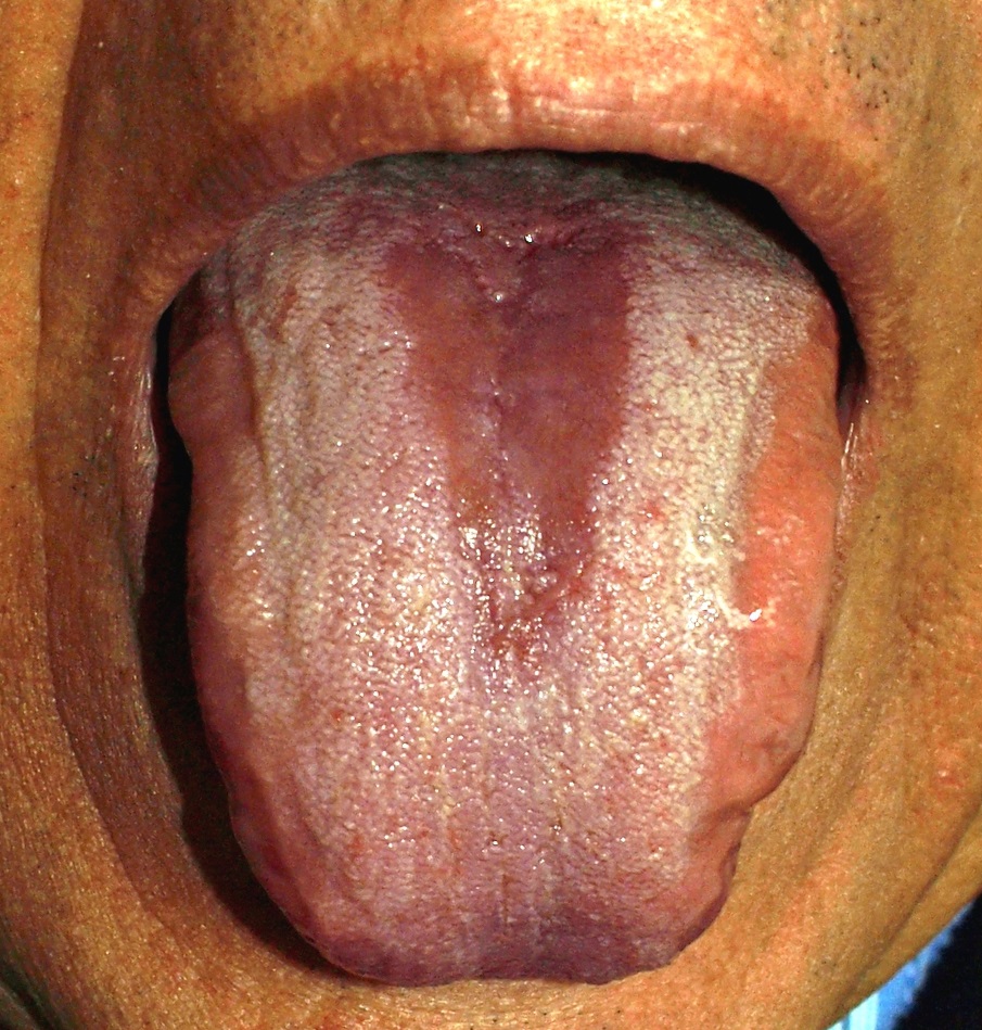 Median rhomboid glossitis.