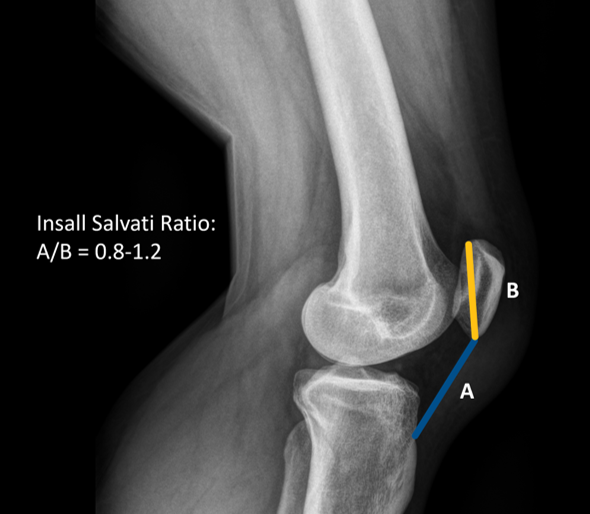 Insall Salvati Ratio