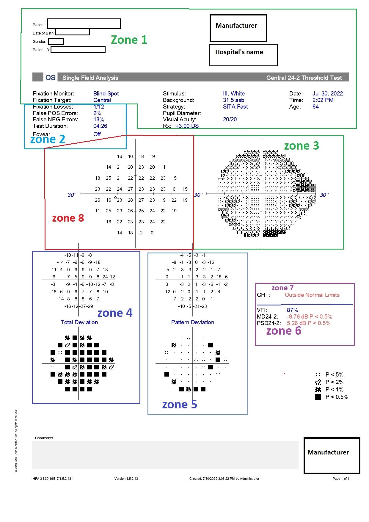 Humphrey visual field printout (24-2 test) with zones