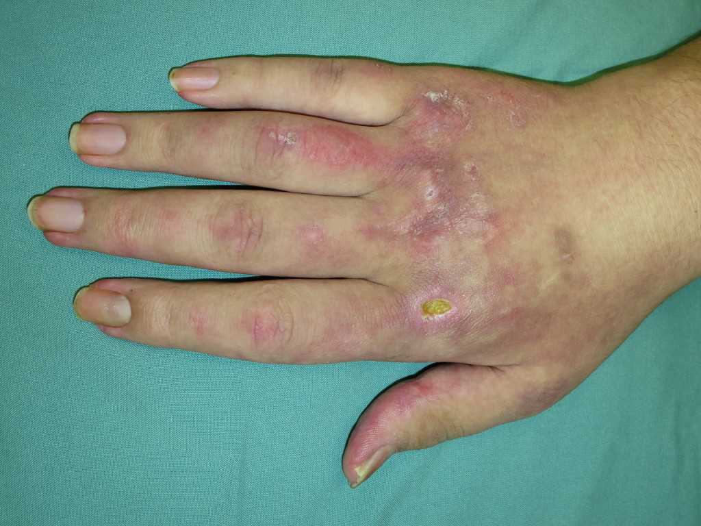 Dermatomyositis