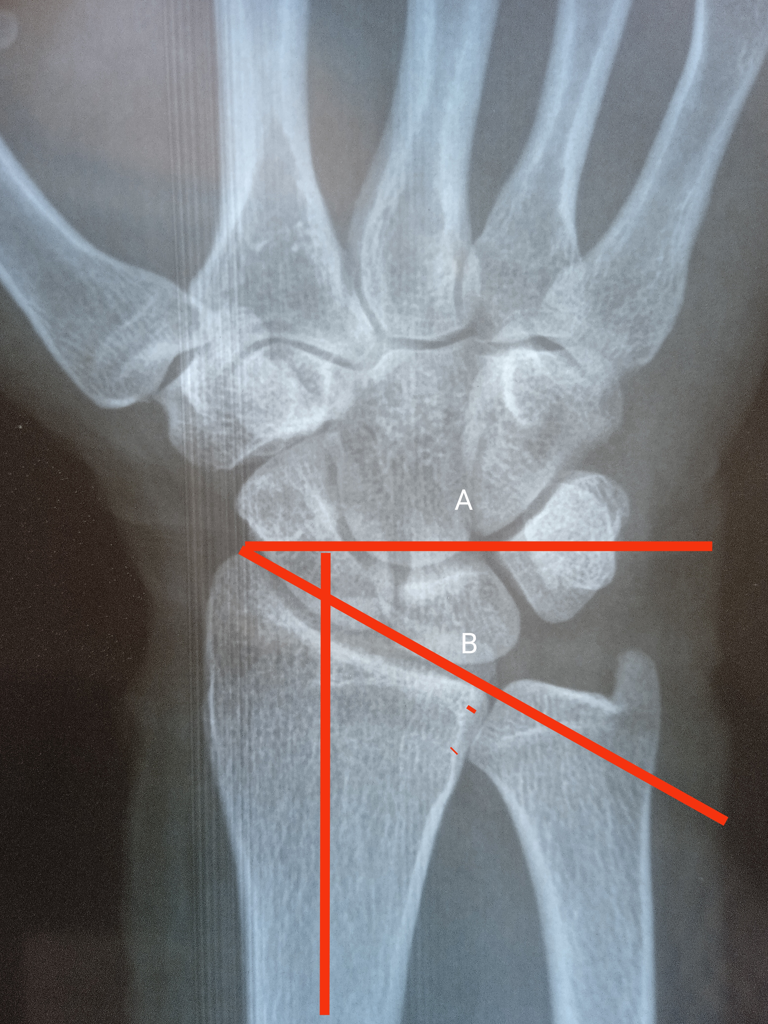 Radial Inclination Angle:
Line A is perpendicular to long axis of radius while line B connects radial and ulnar articular surface of distal radius