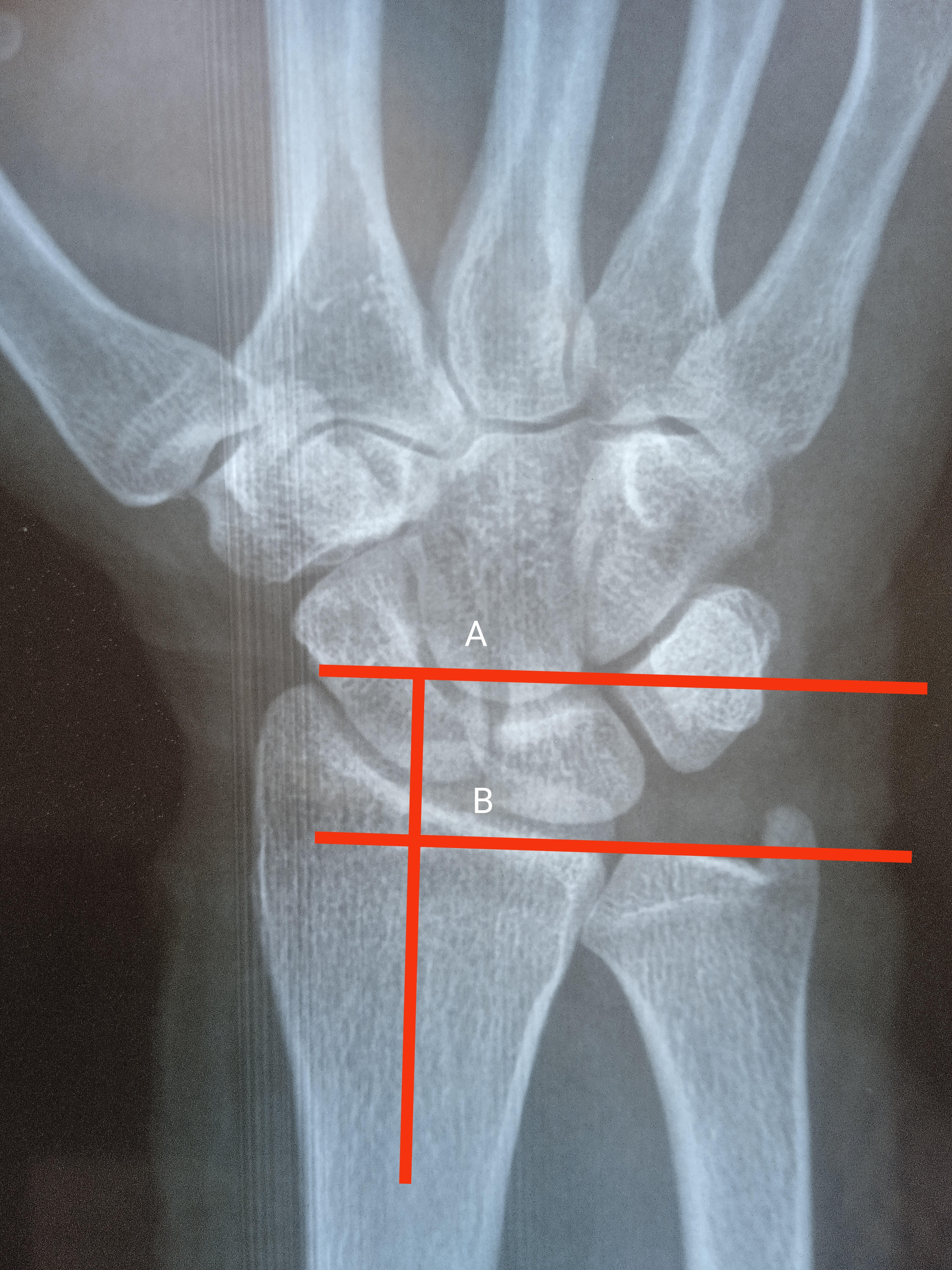 Radial Height:
Both lines are drawn perpendicular to long axis of distal radius