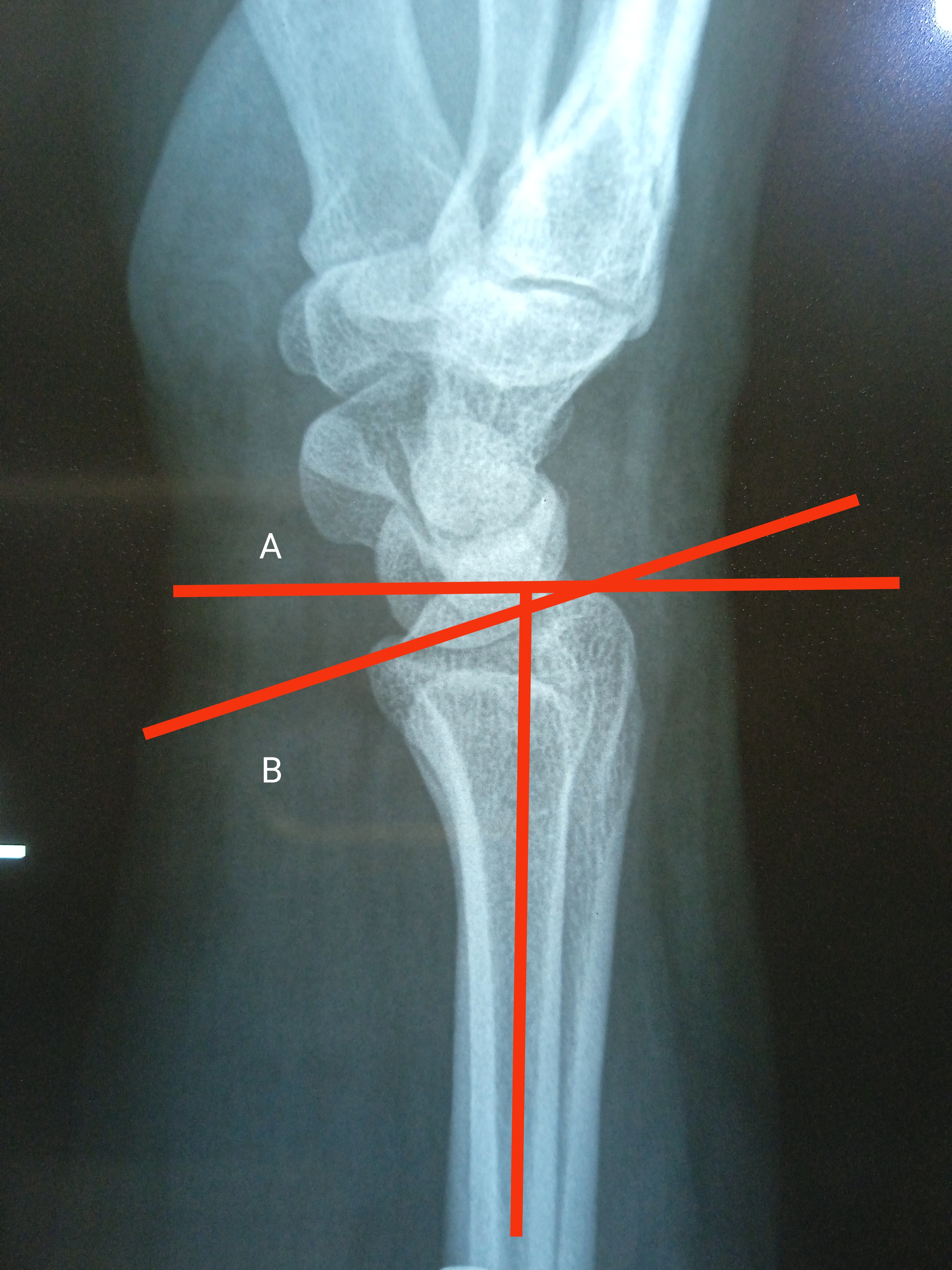 Volar Tilt: Line A is drawn perpendicular to long axis of distal radius and line B connects the dorsal and volar margin of distal radius