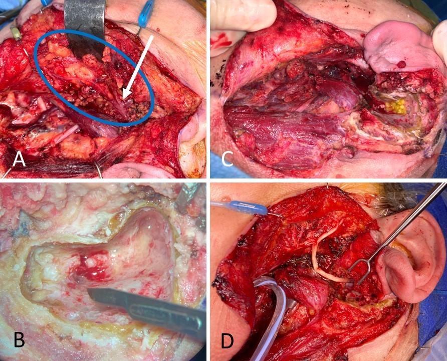 <p>Facial Nerve Reconstruction