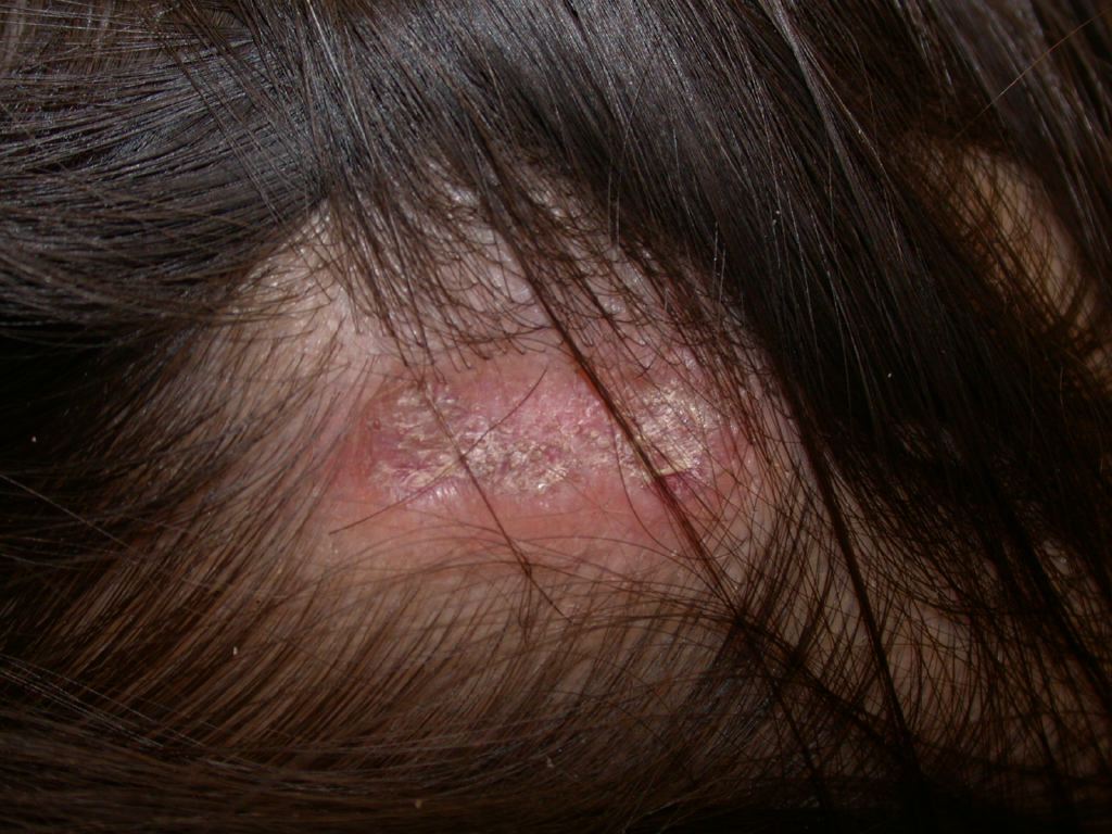 Discoid Lupus, Scalp