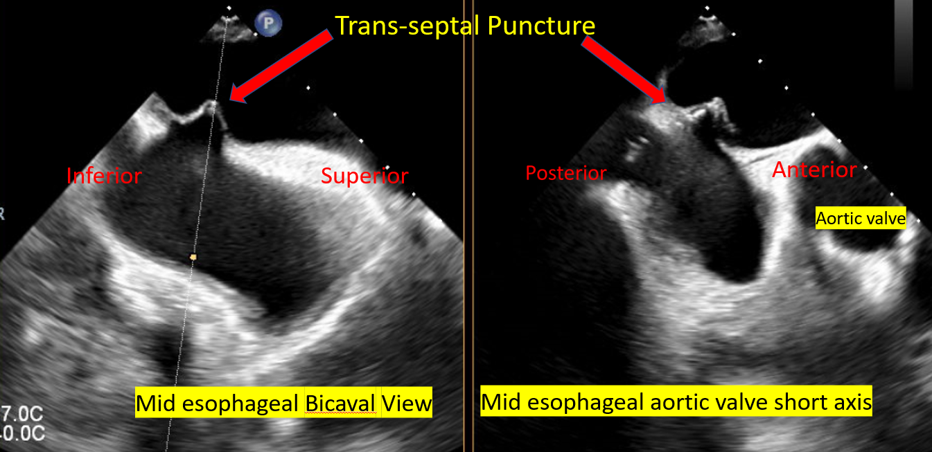 Trans septal Puncture for Mitra Clip Procedure