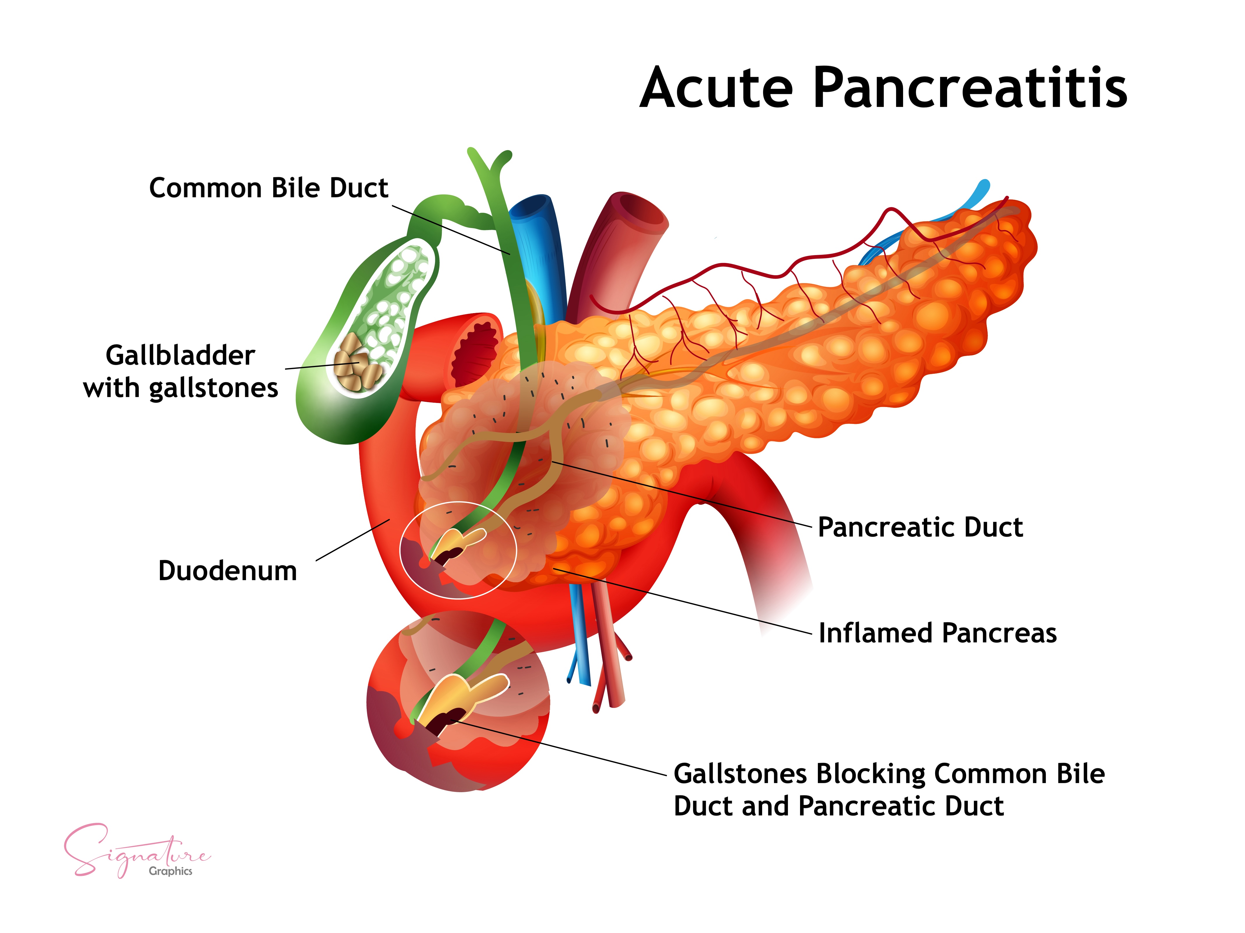 This is a graphic illustration of acute pancreatitis caused by gall stones