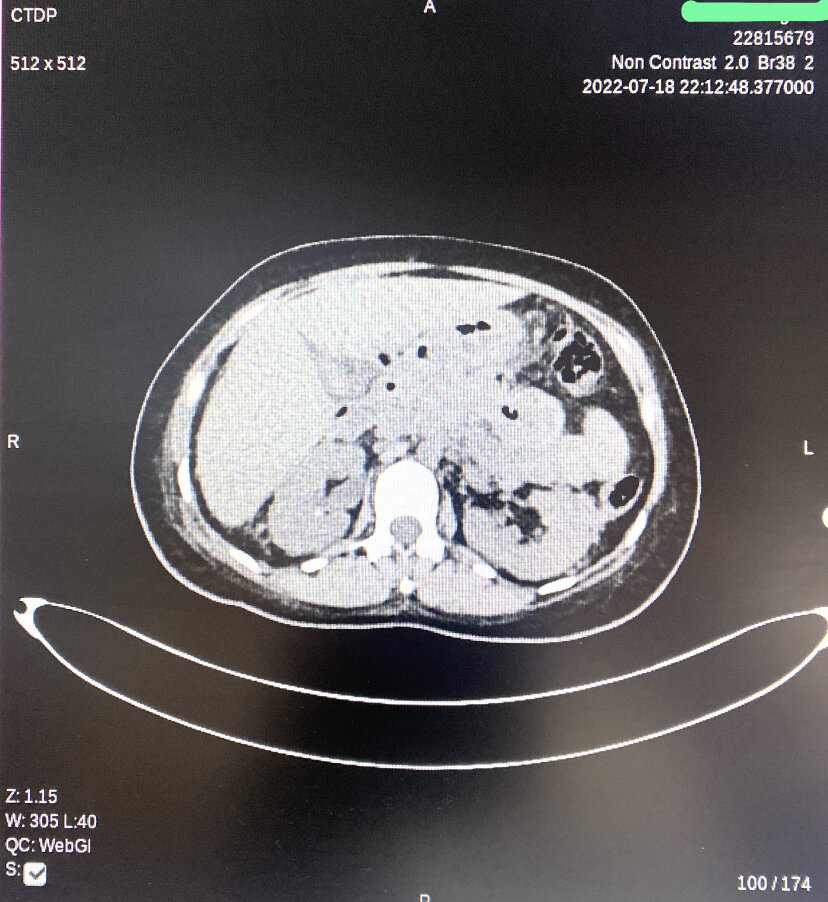 Changes of acute necrotizing pancreatitis with diffusely hypo enhancing pancreas and small non-enhancing areas within the pancreatic parenchyma