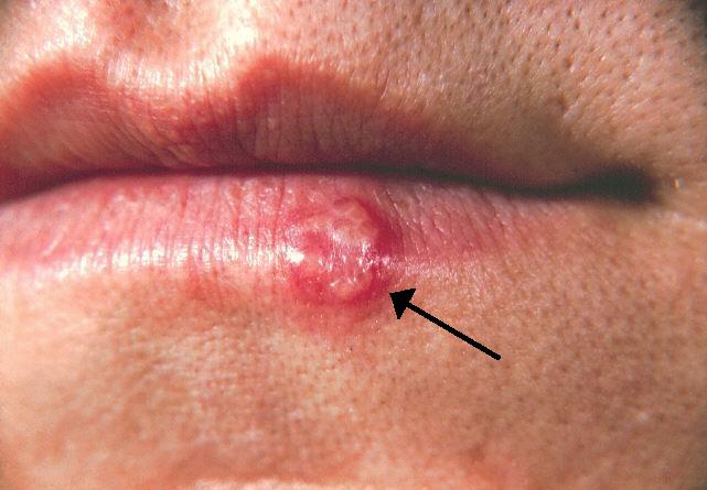 Herpes Labialis.