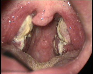 Infectious Mononucleosis.