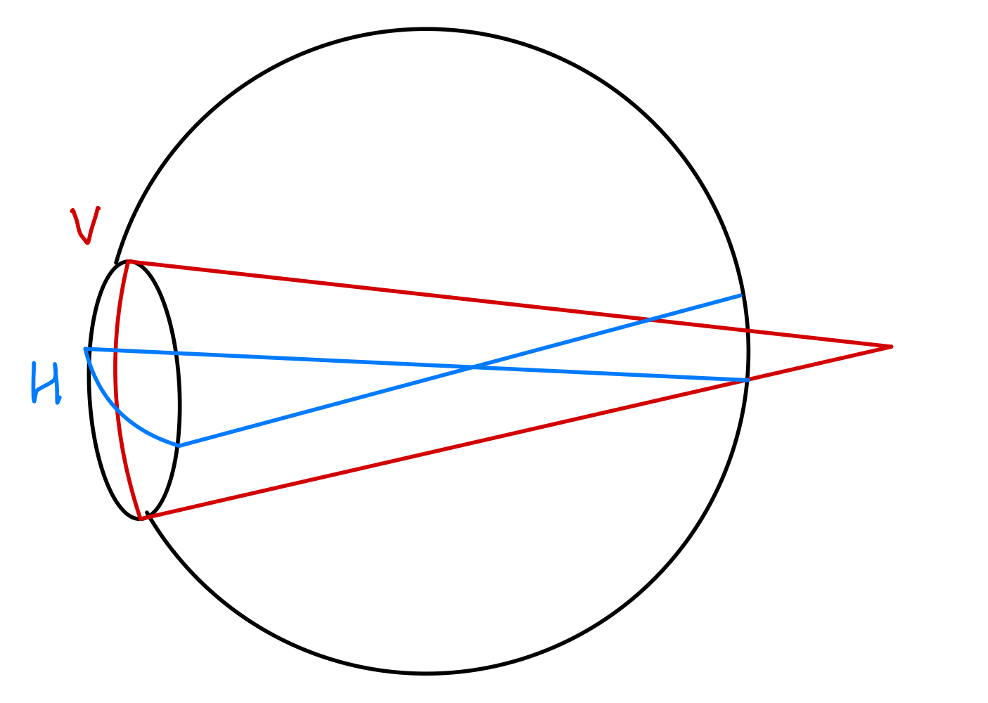 Mixed astigmatism