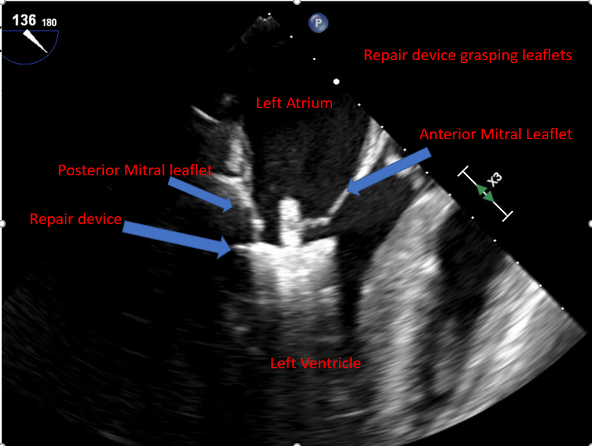 <p>Mitral Valve Leaflet Grasping