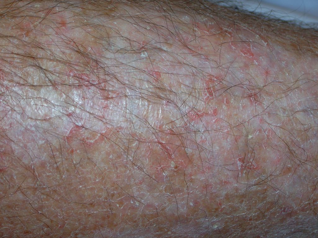 Eczema, Craquele