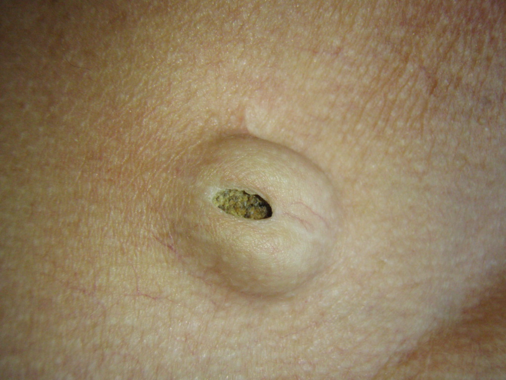 <p>Epidermal Cyst</p>