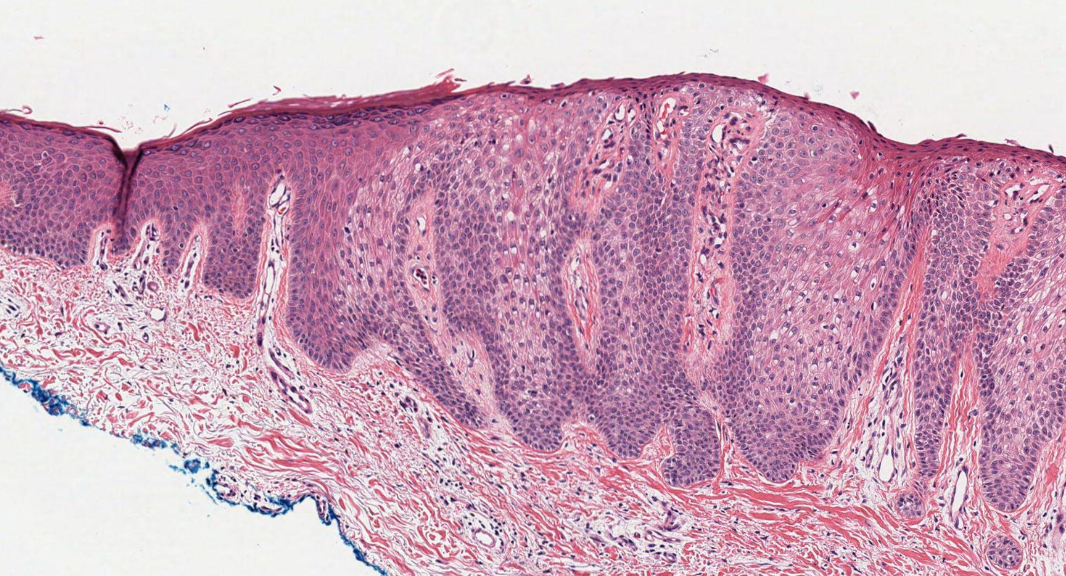 <p>Clear Cell Acanthoma