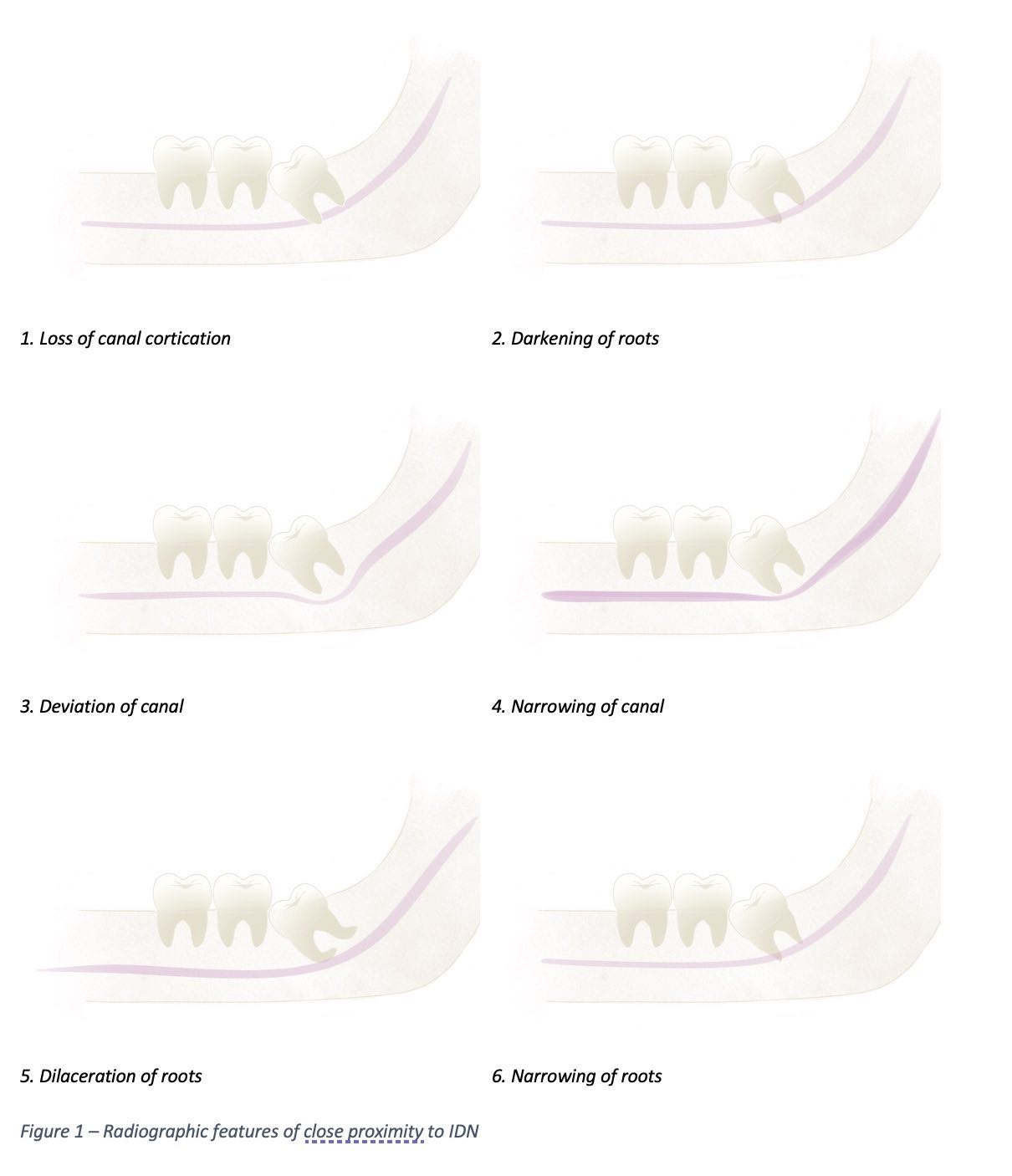 Radiographic features suggestive of close proximity to IDC.