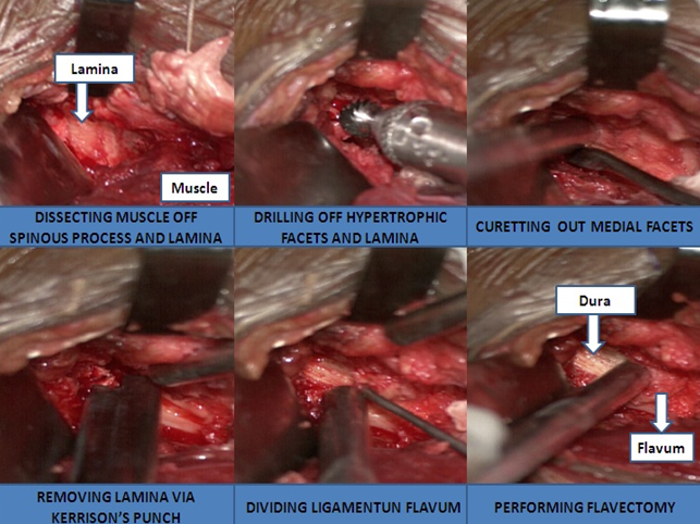 Steps in Micro-lumbar discectomy (MLD)