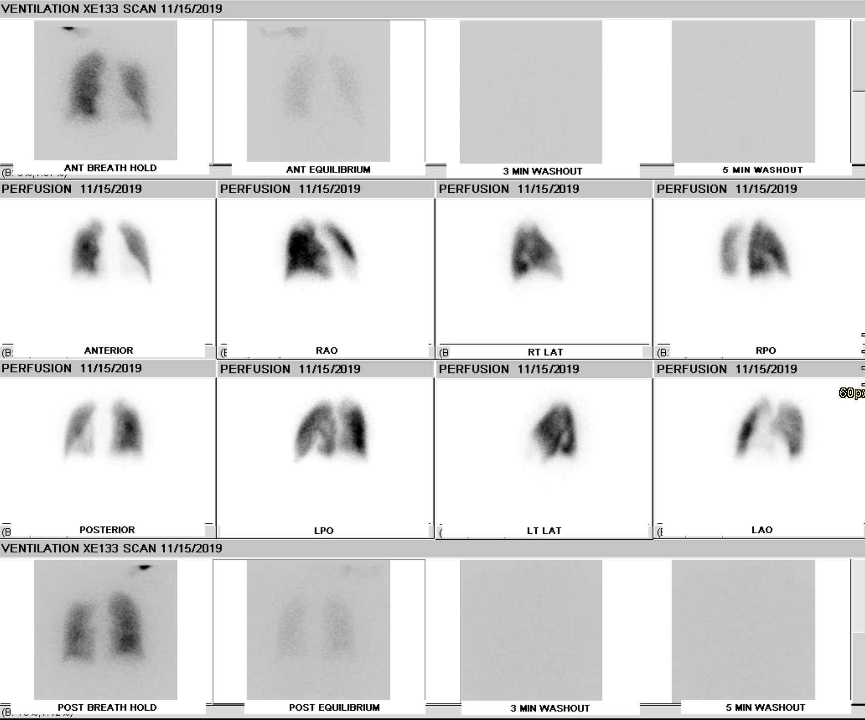 V/Q scan showing moderate sized mismatched perfusion defects which may be seen in chronic thromboembolic pulmonary hypertensi