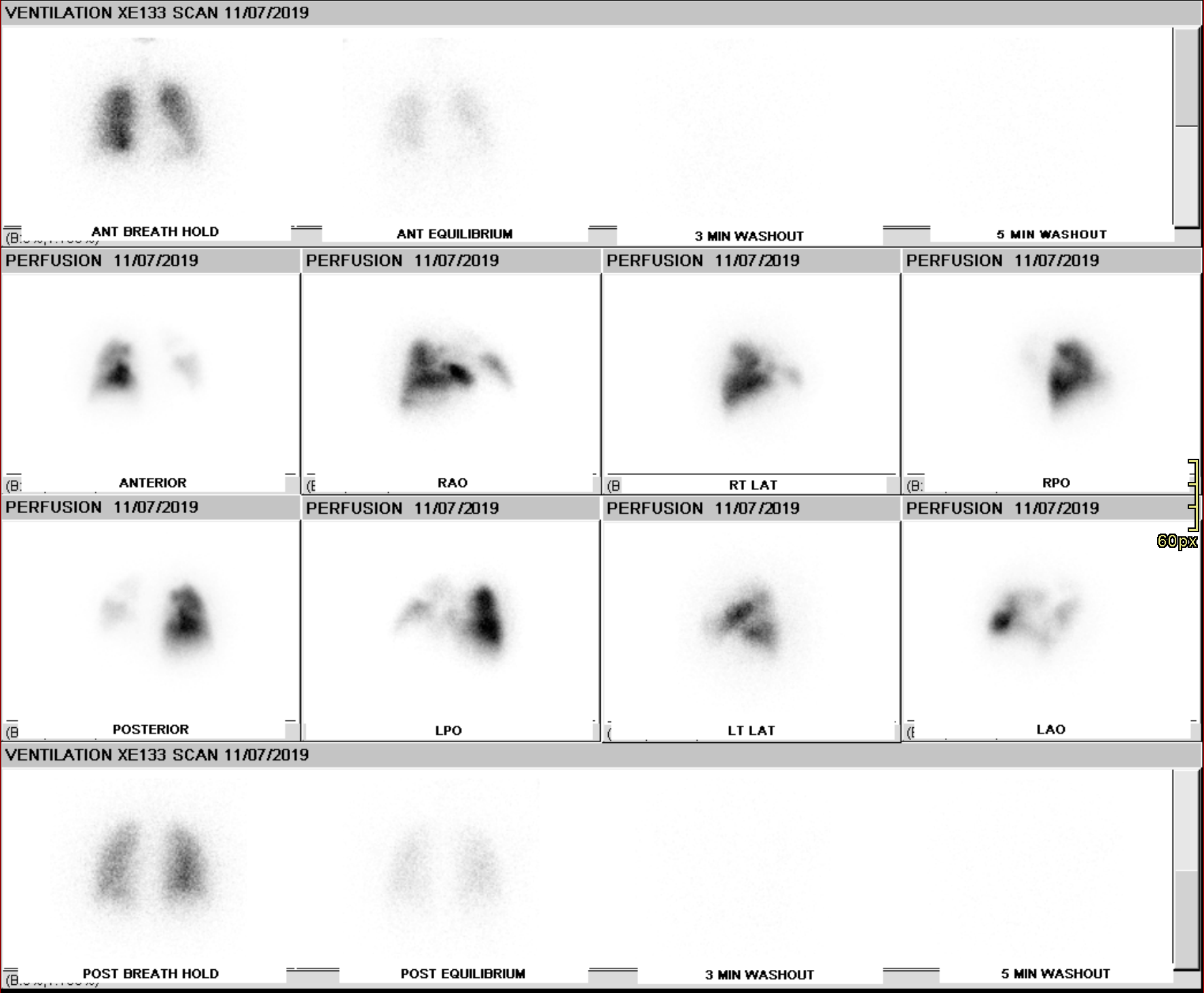 A high probability V/Q scan showing large mismatched perfusion defects.