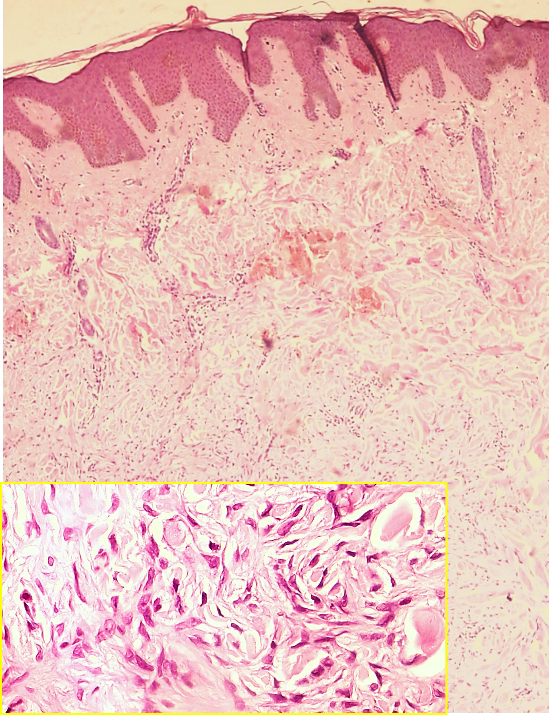 <p>Dermatofibroma