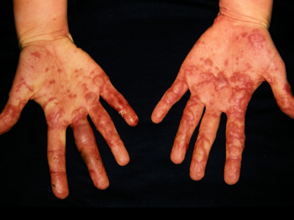 Erythema Multiforme